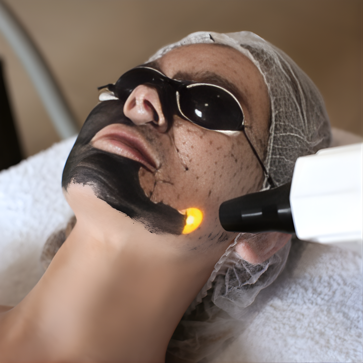 Hollywood Peel (Laser)